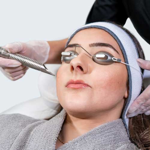 image of the Photo Facial treatment